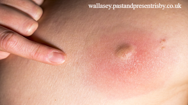 Rekomendasi Obat Bisul Paling Ampuh di Apotik Agar Cepat Sembuh