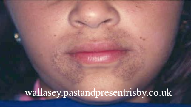 5 Jenis - Jenis Penyakit Langka yang Wajib di Waspadai